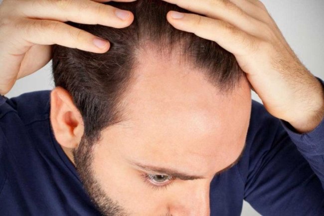 চুল পড়ছে? যা করণীয়…