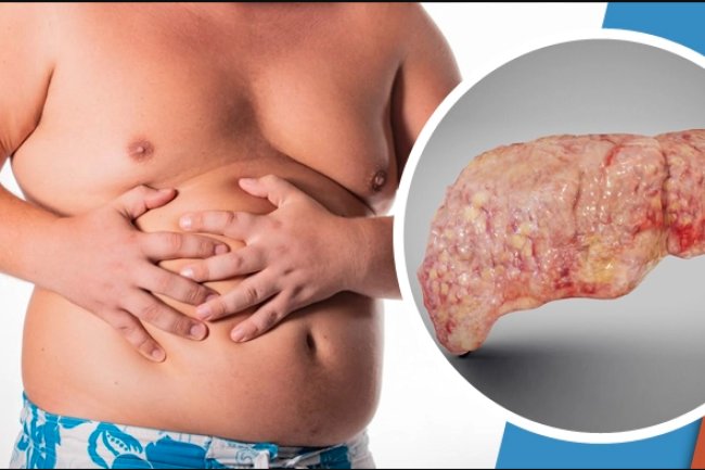 ফ্যাটি লিভার নিয়ন্ত্রণে আনুন ঘরোয়া মাত্র একটি উপায়েই!