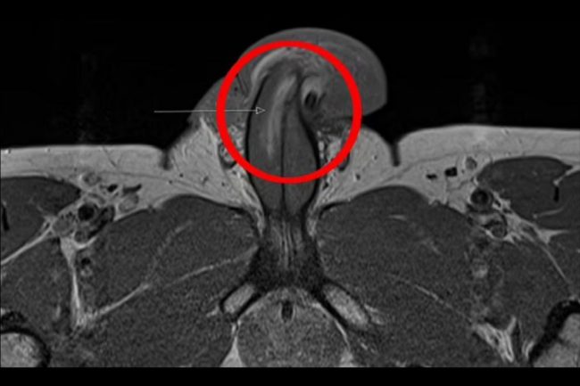 যৌন সঙ্গমের সময় নিজের পেনিস ভাঙ্গলেন ৪০ বছরের পুরুষ!