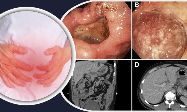 সাধারণ পেটব্যথা নাকি আলসার বুঝবেন যেভাবে